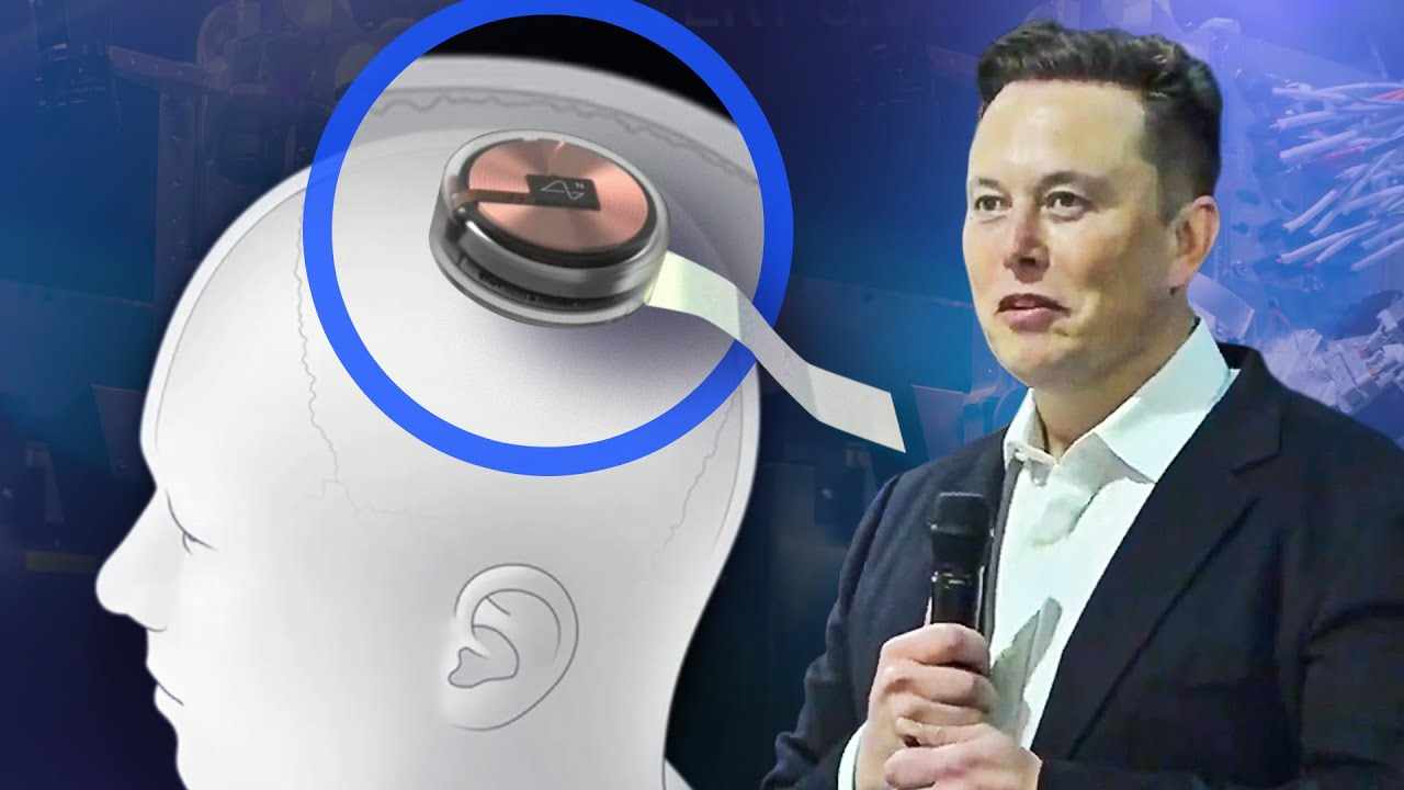 Οι πρώτες δοκιμές τοποθέτησης μικροτσίπ στον ανθρώπινο εγκέφαλο είναι γεγονός
