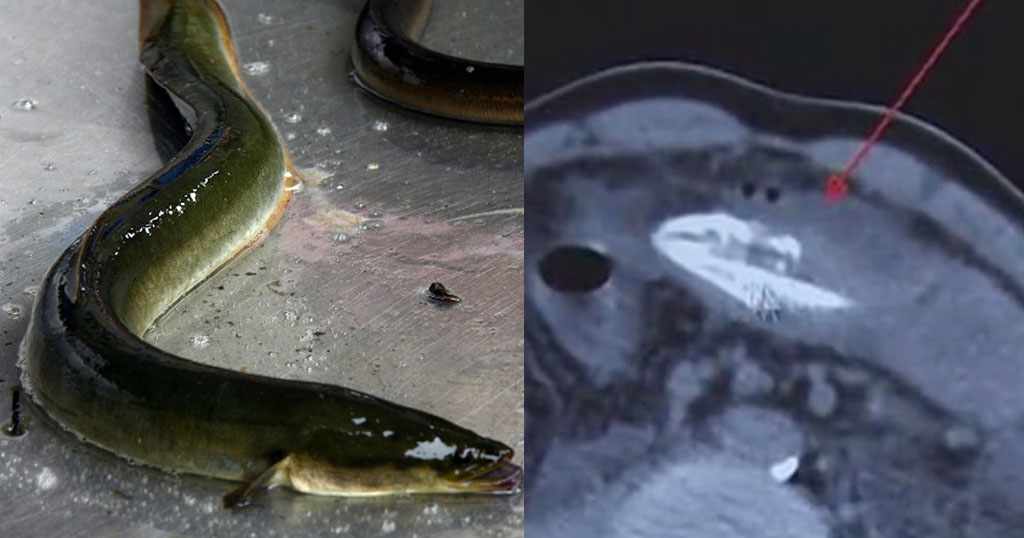 Κινέζος έβαλε στον πρωκτό του χέλι 20 εκ. για να θεραπευτεί από την δυσκοιλιότητα