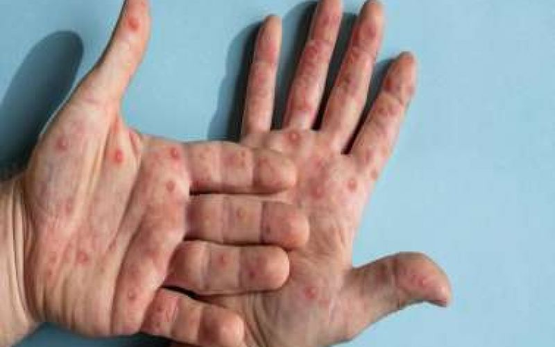 53 επιβεβαιωμένα κρούσματα της mpox
