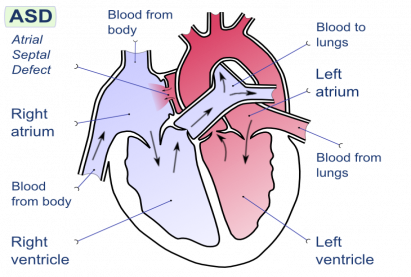 Diver's disease